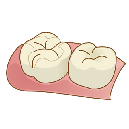 セラミックインレー