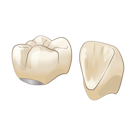 ハイブリッドセラミッククラウン