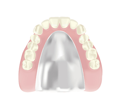 コバルトクロム床義歯