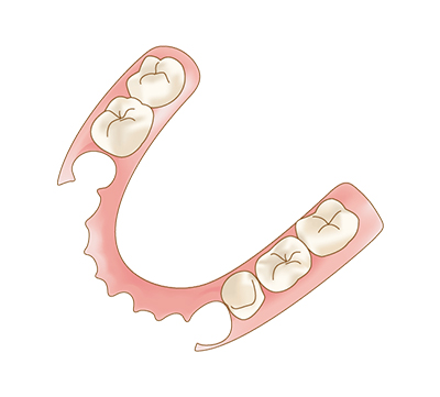 ノンクラスプデンチャー