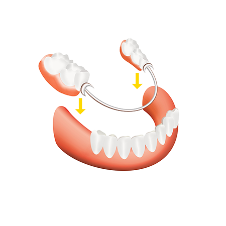 マグネットデンチャー